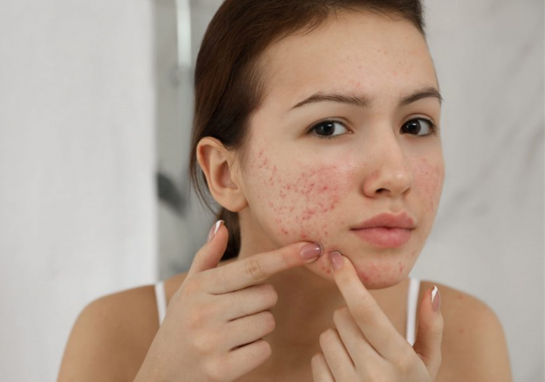 Spotlight On Acne: Top 10 Tips To Clear Your Skin Fast!