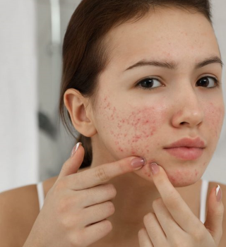 Spotlight On Acne Top 10 Tips To Clear Your Skin Fast